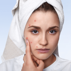 acne (pimples and breakouts)